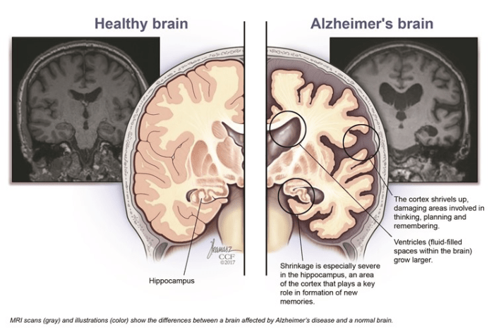 Alzheimer's disease early onset hesi case study